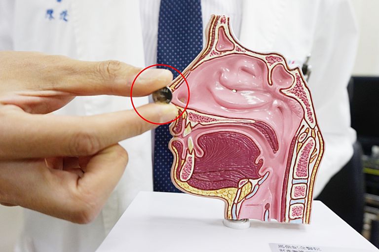 水银电池塞男童鼻骨穿孔 新竹马偕:家长须留意勿让小孩把玩
