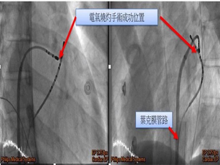 臺大分院新竹醫院跨縣市葉克膜救援急救挽救一條生命 亞太新聞網ata News